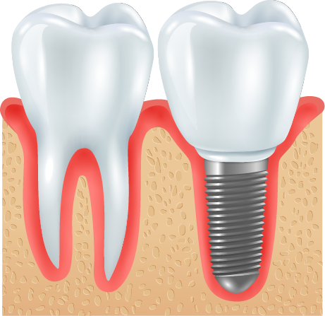 Full Implant